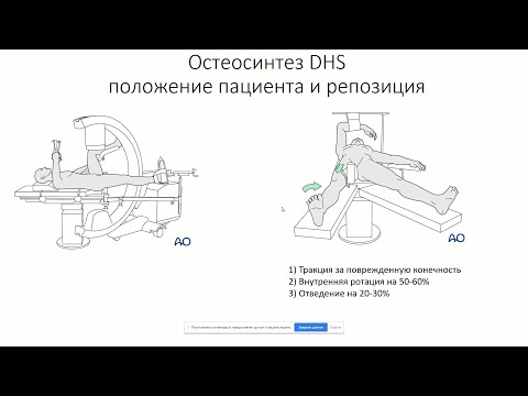 Лекция секции травматология: Переломы шейки бедра