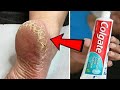 Eliminate Cracked Heels and Get White Smooth Feet / Cracked Heels Home Remedy