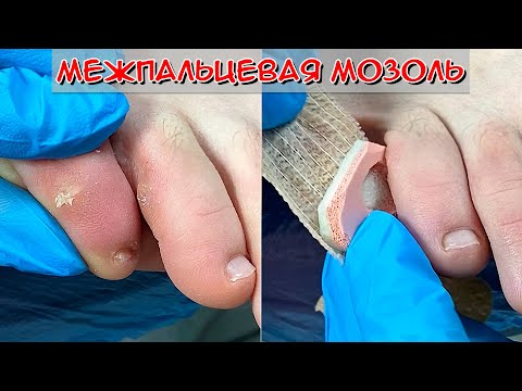 Стержневая мозоль удаление / Межпальцевая мозоль на ноге