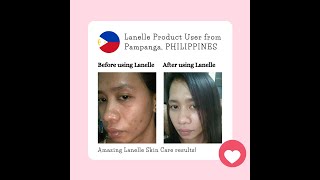 Mie O. of Pampanga, Philippines LANELLE Picture Testimonial 1 Month Usage; Lanelle Milanie Torralba