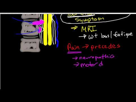 Oncologic Emergencies: Spinal Cord Compression