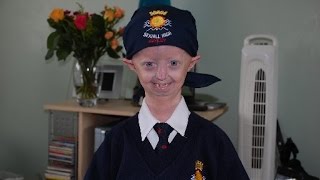 Progeria sufferer Hayley Okines dies, aged 17