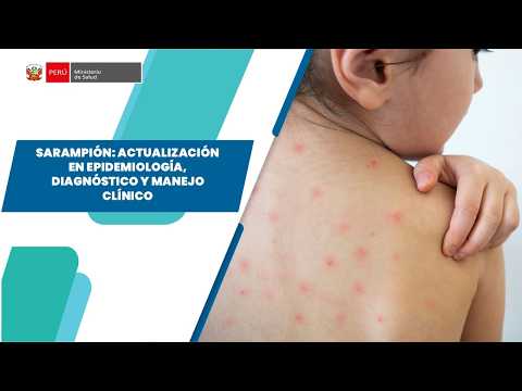 SARAMPIÓN: ACTUALIZACIÓN EN EPIDEMIOLOGÍA, DIAGNÓSTICO Y MANEJO CLÍNICO