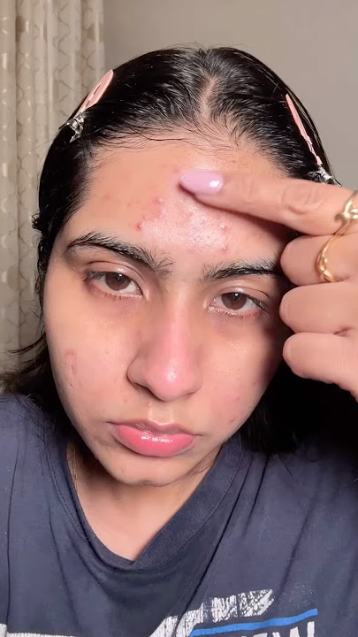 Forehead acne solution #acneproneskin #skincareroutine #skincaretips