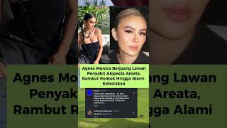 Agnes Monica Berjuang Lawan Penyakit Alopecia Areata