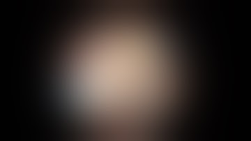 Transurethral Resection of Bladder Tumor (TURBt)