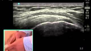 How to: Ultrasound Guided Shoulder Injection screenshot 2