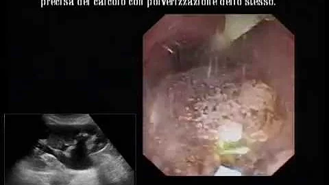 Come funziona la litotrissia?
