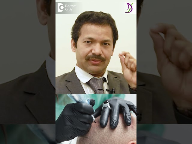 INSTANT HAIR LOSS SOLUTION | Scalp Micropigmentation -Dr. Deepak P Devakar | Doctors' Circle #shorts class=