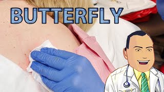 Butterfly C Y S T Removal