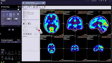 syngo via VB10 MI Neurology Subtraction (Phép trừ MI thần kinh)