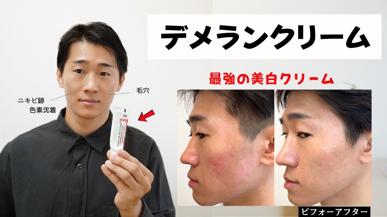 【美白】デメランクリームの効果と使い方！毛穴・ニキビ跡・ニキビ・シミ・クレーターに塗ってみた経過がヤバい。