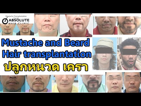 รีวิว ปลูกหนวด เครา Review Mustache and Beard hair transplantation from Absolute Hair Clinic