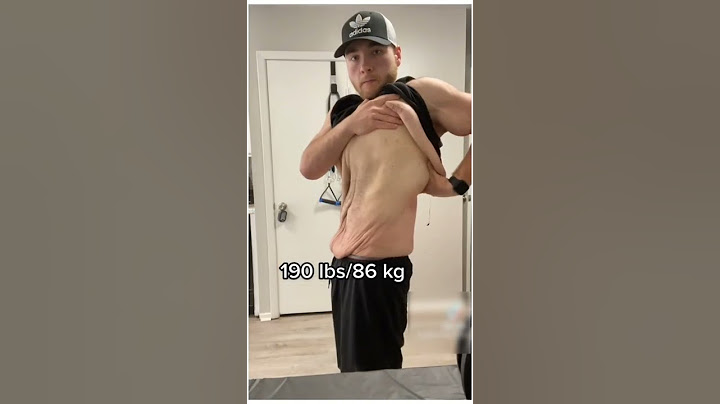 FROM EXTREME OBESE TO EXTREME WEIGHT LOSS