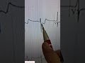 الجلطة القلبية في دقيقة الجلطة القلب Ecg الجلطة القلبية في دقيقة الجلطة القلب Ecg