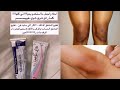 اقوى واجمل شيء جربته لتفتيح الركب والأكواع والمناطق الغامقة والحساسة في الجسم لجين قفاص 