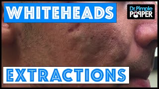 Whitehead extractions on a patient with improving acne