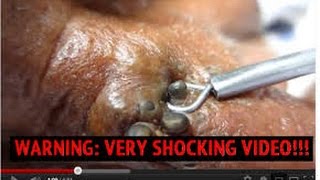 Biggest Blackhead lipoma cyst, boil, zit in NEW!! ┇┇ Blackhead Z Channel Youtube2015
