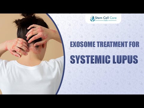 How Exosomes Help Treat Systemic Lupus (SLE)