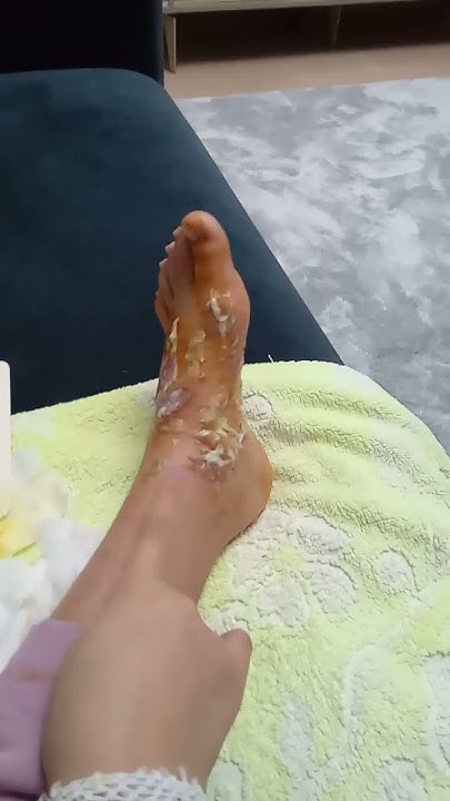 Kızgın yağ yanığı su toplaması nasıl geçer