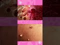 3D Animation on Vaginoplasty #meddco #healthcare #surgicalprocedure