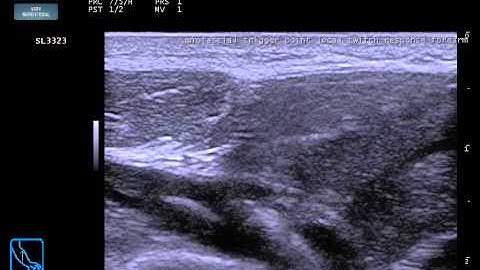 Myofascial Trigger Point with LTR by Dr. Pink