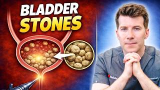 What Are Bladder Stones? Symptoms, Causes & When to Seek Help | Doctor explains
