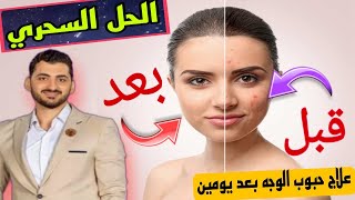 التخلص من حبوب الوجه بطريقه سحرية | في يومين فقط تخلصي من حبوب الوجه