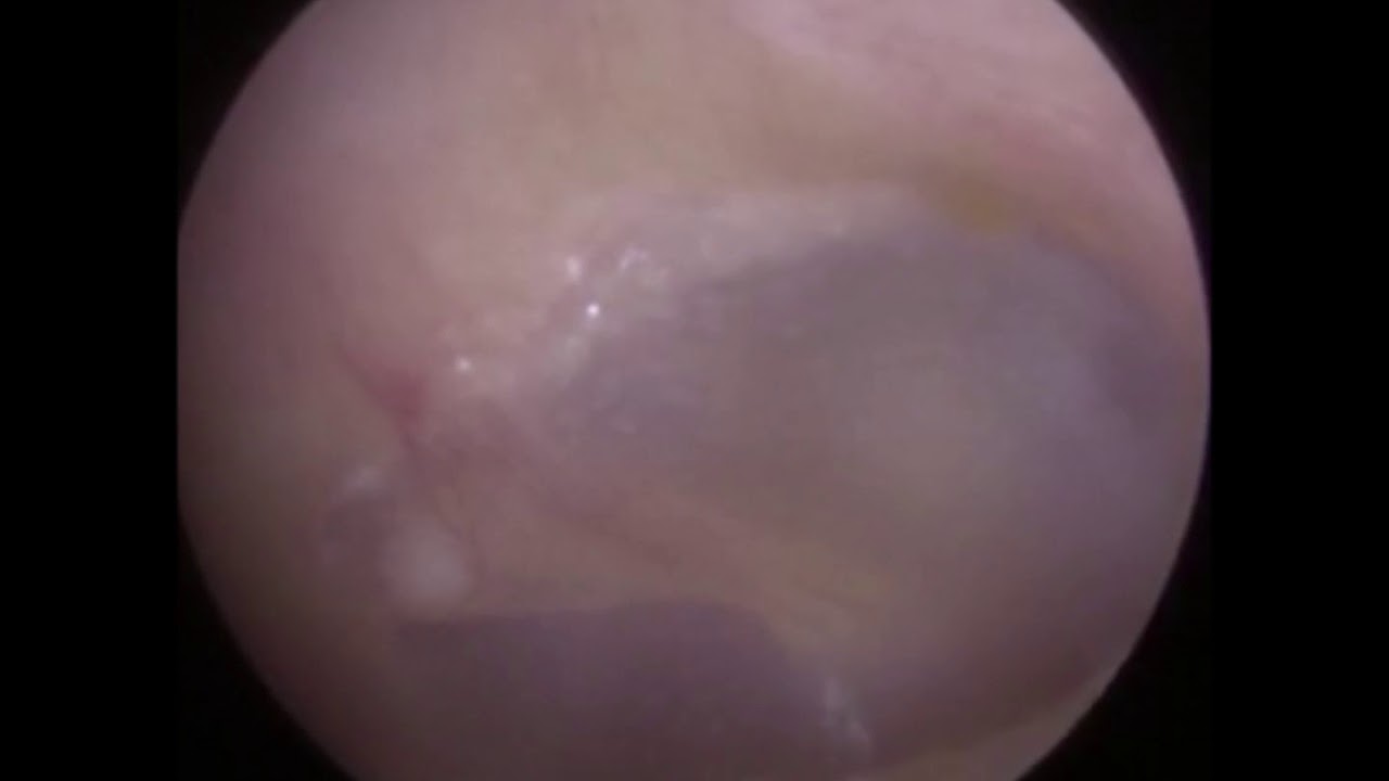 impacted ear wax removal at home