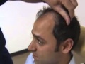 Hair Loss Treatments and Balding