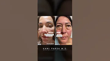 What S The Difference Between Malar Edema And Eye Bags Dr Kami Parsa 