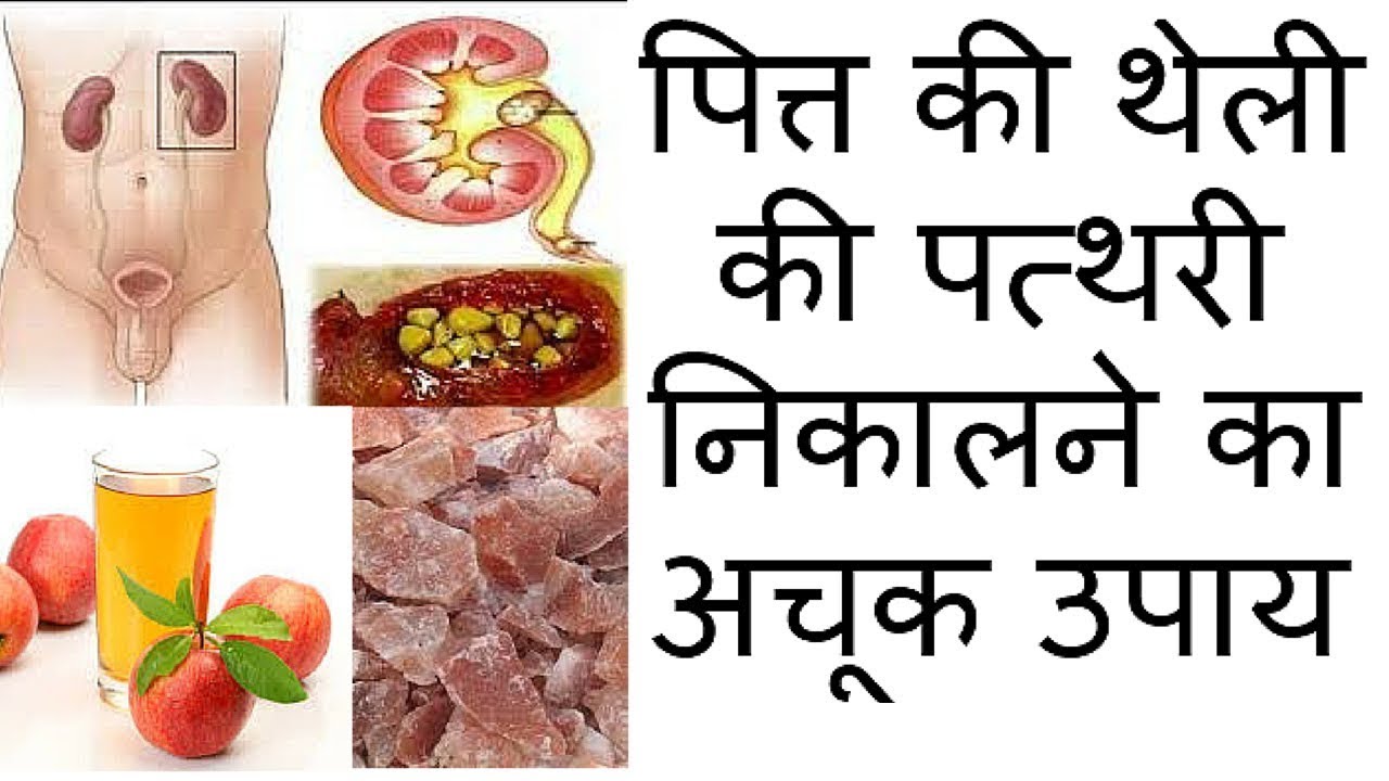 पित्त की थेली की पत्थरी निकालने का अचूक उपाय YouTube