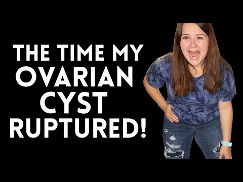 My Ovarian Cyst Ruptured *Story Time*