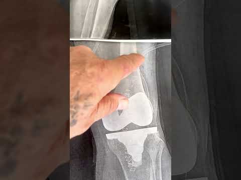 Рентгеновские снимки колена, ДО и после замены коленного сустава .