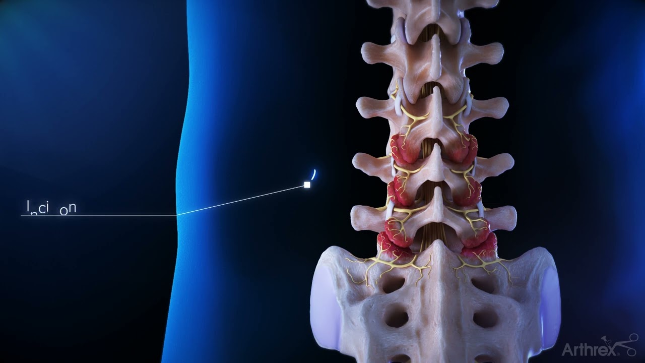 Endoscopic Medial Branch Nerve Transection | Desert Institute for Spine Care