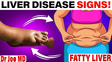 8 Signs of Liver Disease (Fatty Liver) You Can