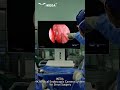Experience precision in sinus surgery with the IKEDA 4K Medical Endoscopic Camera System