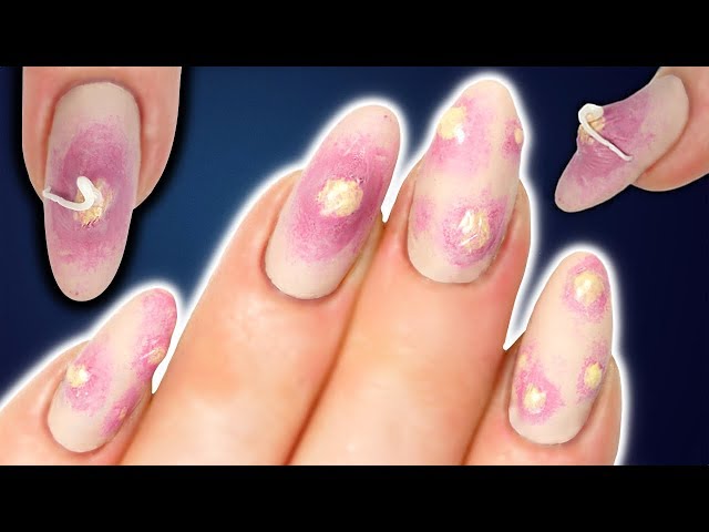 How to Treat an Allergic Reaction to Gel Nail Polish