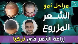 مراحل نمو الشعر المزروع بعد إجراء عملية زراعة الشعر في تركيا