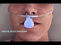 Medical device animation by arcreative media 3d medical device animation