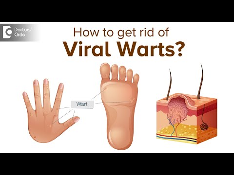 What are Viral Warts and what do we  need to know about it? - Dr. Divya Sharma|Doctors' Circle