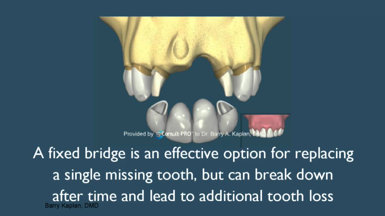 Dr. Barry A. Kaplan | Missing Teeth