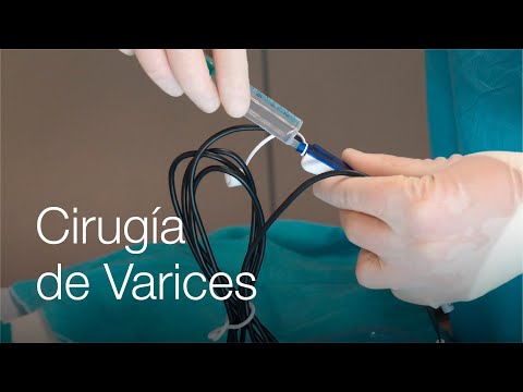 Vídeo: 3 maneres d'alleujar el dolor de les venes varicoses