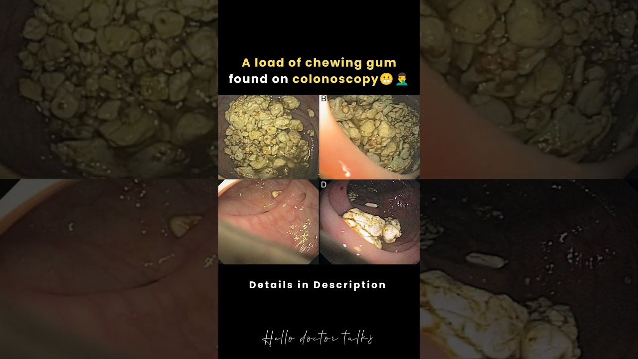 A load of chewing gum found on colonoscopy Details in description 👍  #healthchannel #doctorslife