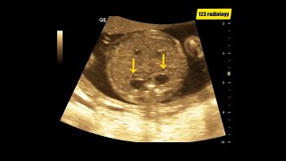 19 weeks baby boy with bilateral hydronephrosis | Ultrasound Case | Ob | screenshot 4