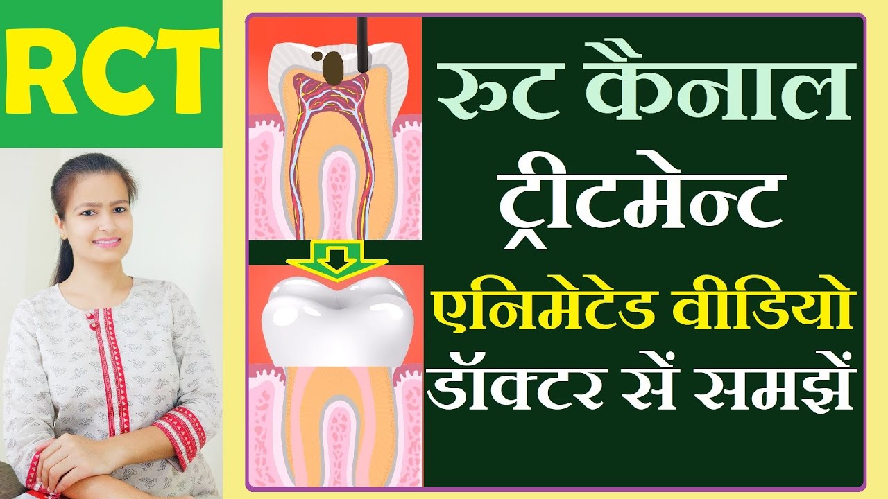 RCT TREATMENT VIDEO rct in hindi Root canal treatment in hindi