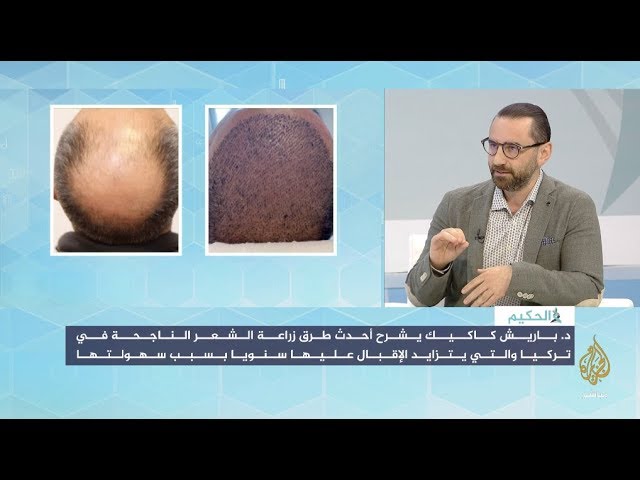 أحدث تقنيات زراعة الشعر في تركيا