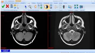 DISCUSION DE CASOS CLINICOS DE NEURORADIOLOGIA CON RESIDENTES CON RETROALIMENTACION DISCUSION DE CASOS CLINICOS DE NEURORADIOLOGIA CON RESIDENTES CON RETROALIMENTACION