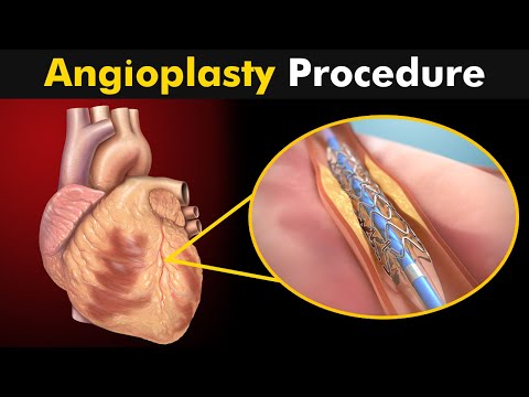 Видео: Ангиопластикийг хэзээ хийдэг вэ?