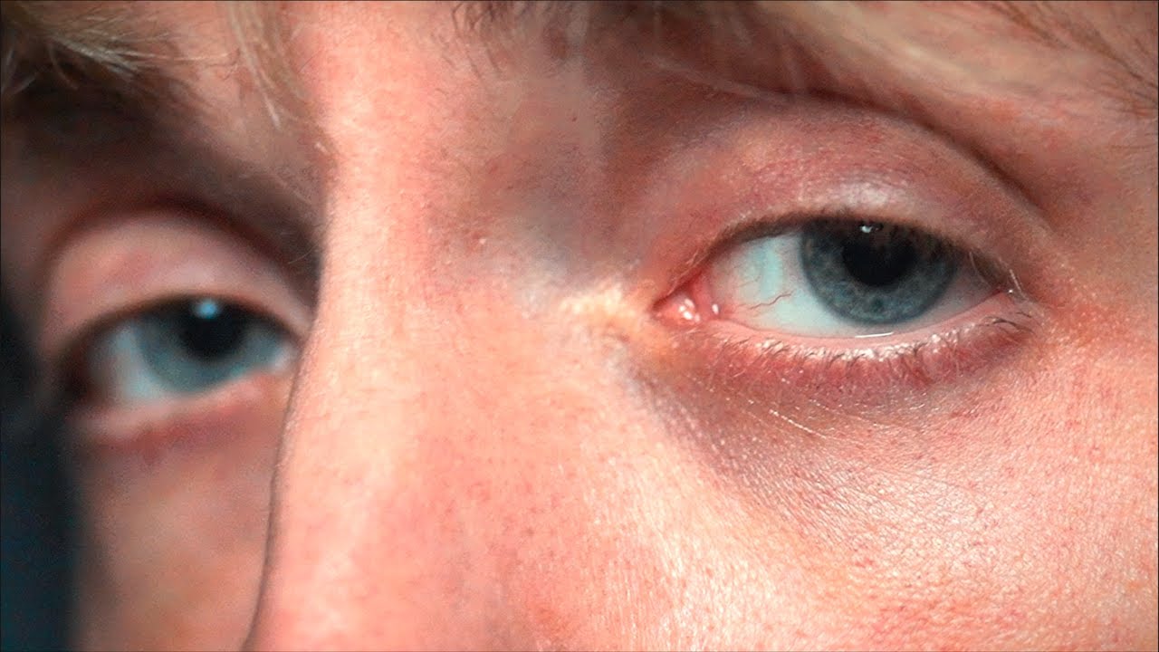 Why Do I Have a Red Ring Around My Iris? - DMEI | Dean McGee Eye Institute